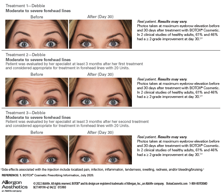 Botox Before and After Results in 3 Treatments