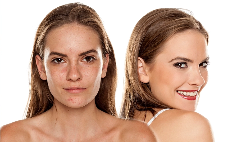 Acne facial treatment