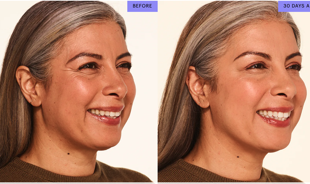 Botox treatment results for crow's feet lines