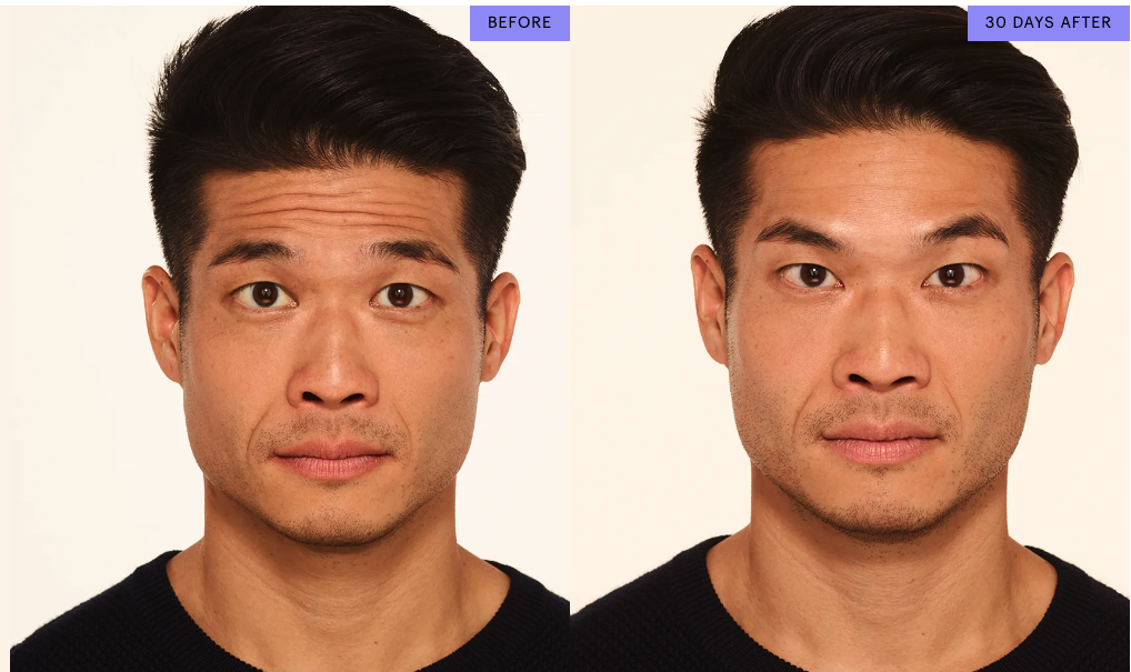 Botox treatment results for forehead lines