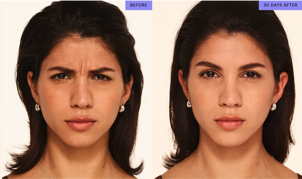 Botox treatment results for frown lines