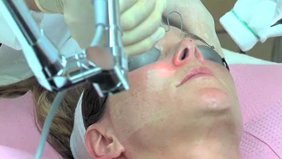 Sciton Tunable Resurfacing Laser Treatment at NW Medical Arts