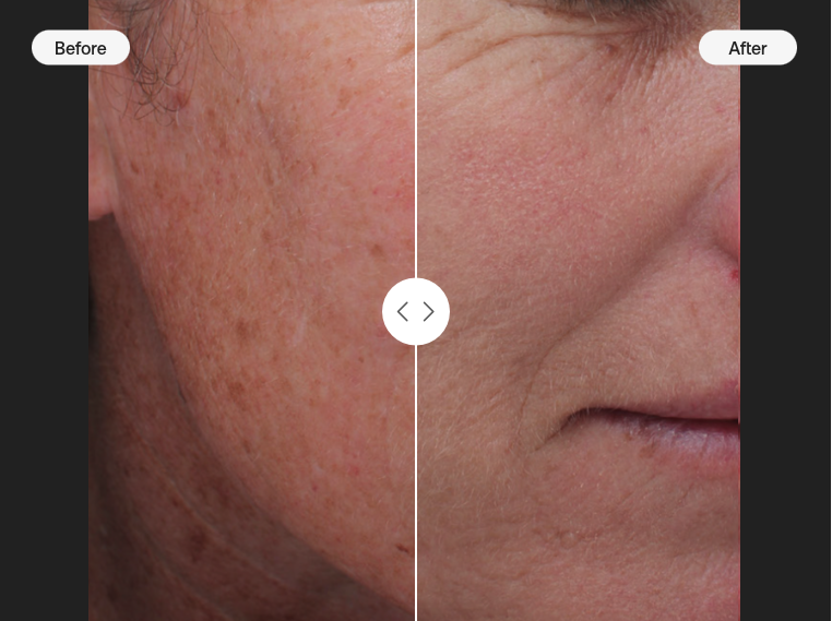 MOXI Laser Treatment Before and After Results