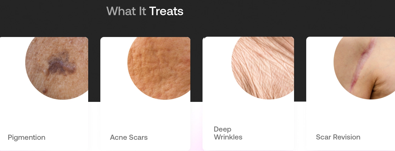 Sciton TRL Laser Treatment Capabilities - Pigmentation, Acne Scars, Deep Wrinkles, Scar Revision