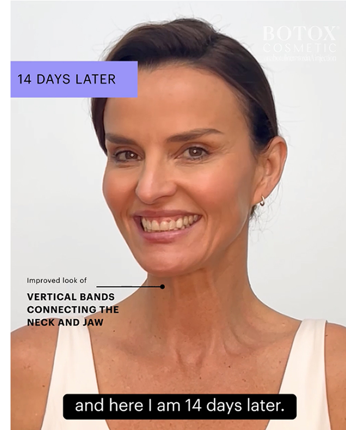 Botox Neck & Jawline Lift 14 Days After Treatment