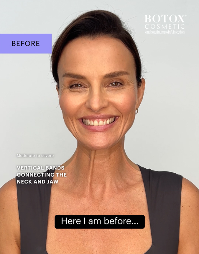 Botox Neck & Jawline Lift Before Treatment
