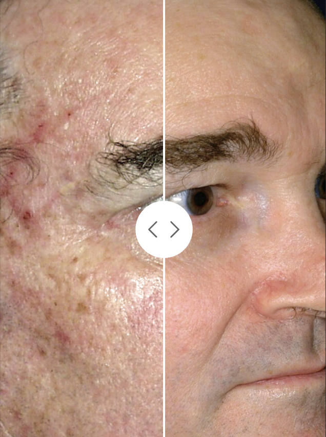 Sciton MicroLaserPeel before and after laser skin resurfacing results following two treatments, Case 1