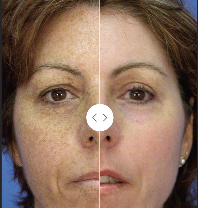 Sciton MicroLaserPeel before and after skin resurfacing results five months after one treatment, Case 2
