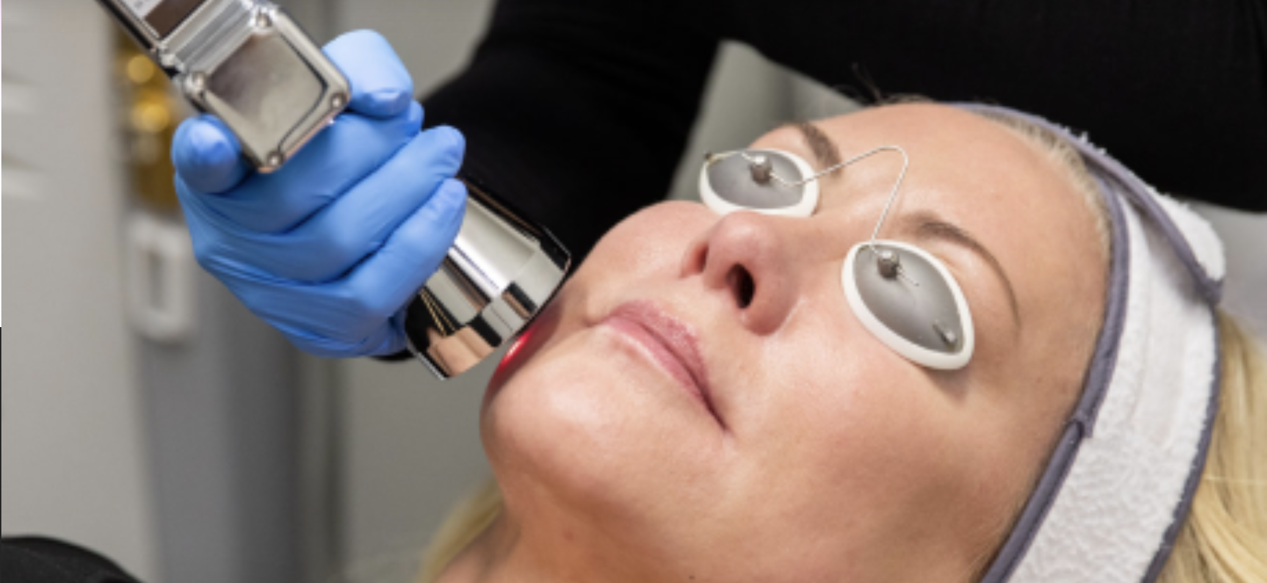 Sciton MicroLaserPeel erbium laser skin resurfacing treatment near Tacoma Washington